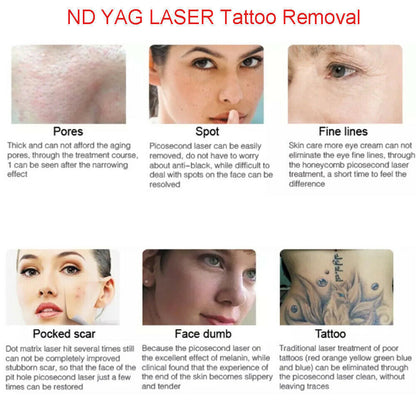 ND YAG Laser Tattoo Removal Pigmentation Treament Carbon Peeling Beauty Q-switch Machine