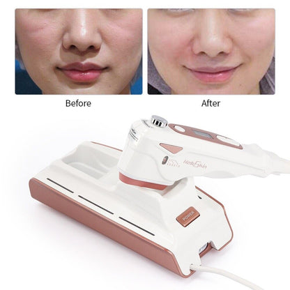 Handheld Ultrasonic HIFU Skin Machine Radio Rejuvenation Face Lifting Anti-aging