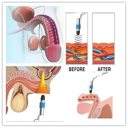 Air Pressure Shockwave Erectile Dysfunction Therapy Machine ED Treatment Massager