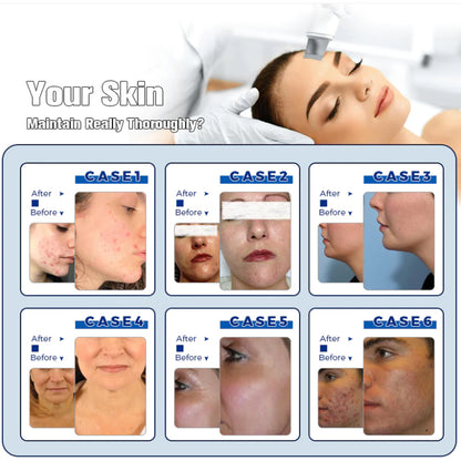 14IN1 Facial Hydro Dermabrasion Diamond Aqua Peeling Oxygen Jet Spa Skin Rejuvenation Machine